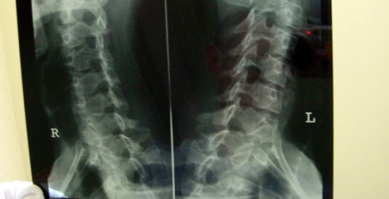 x-ray