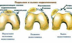 Вывих надколенника