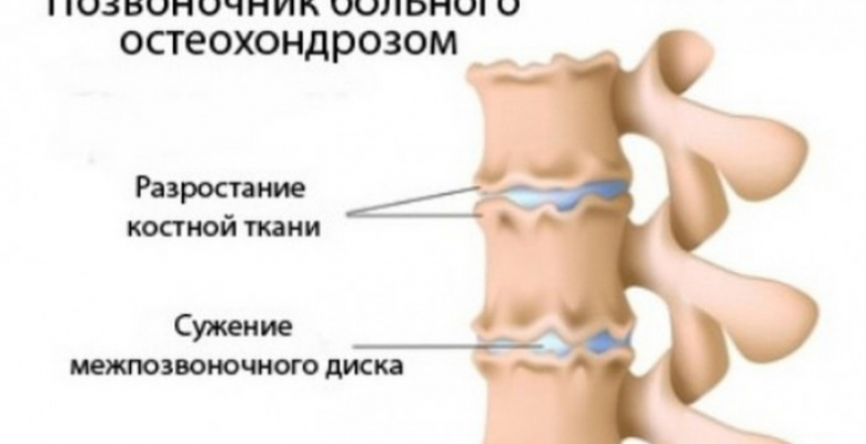 lechebnaya-fizkultura-pri-osteohondroze-poyasnichnogo-otdela-pozvonochnika