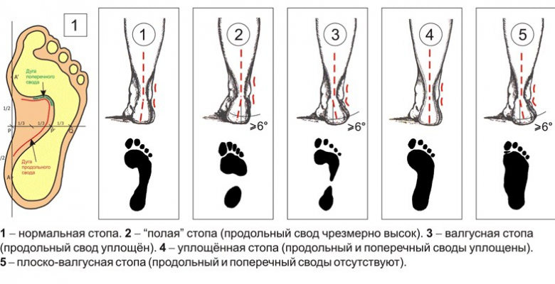 1465345460_ploskostopie-stepeni