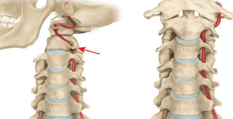 sindrom-pozvonochnoy-arteriy1