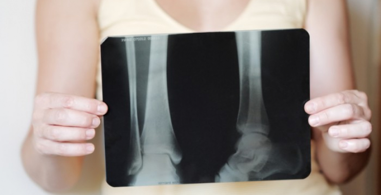 Woman holding an x-ray image on foot