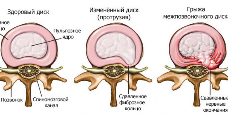 vozniknoveniya-grizhi-pozvonochnika