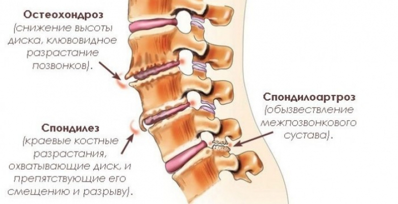 spondilez