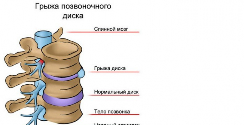 Gryzha-pozvonochnogo-diska