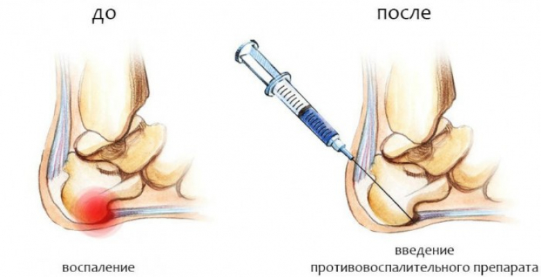 vylechit-pyat-shpor-4