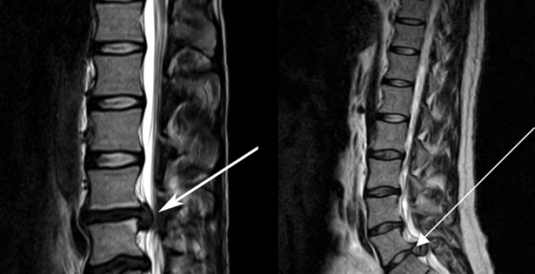 cauda-equina-spinal-MRI