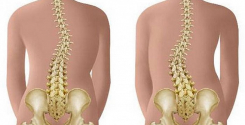 Skolioz-----patologicheskoe-iskrivlenie-2