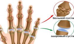 Причины остеоартроза кистей рук