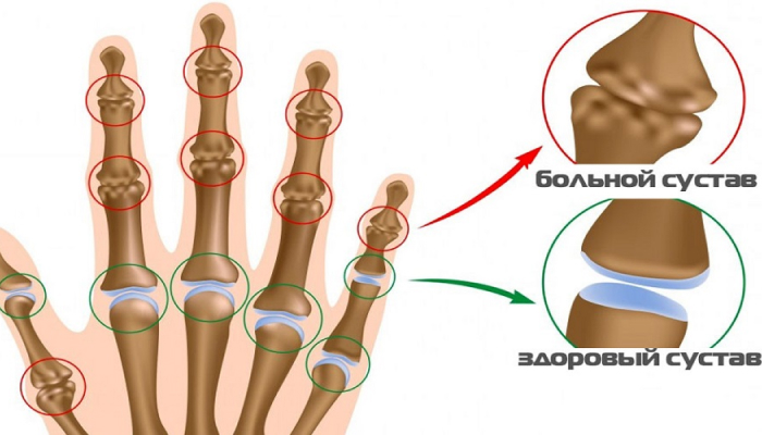 Причины остеоартроза кистей рук