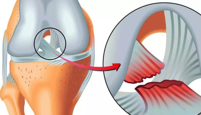 Разрыв крестообразной связки колена