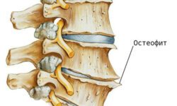 Остеофиты позвоночника. Лечение