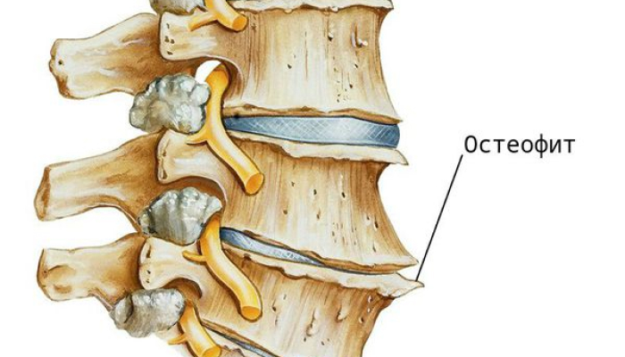 Остеофиты позвоночника. Лечение