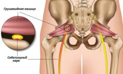 спазм грушевидной мышцы бедра
