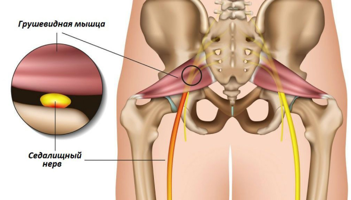 спазм грушевидной мышцы бедра