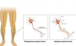 Полиневрит – множественное поражение нервных волокон