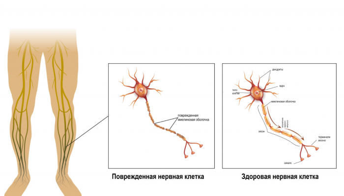 Полиневрит – множественное поражение нервных волокон