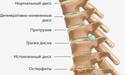 Остеохондроз шейного и поясничного отделов