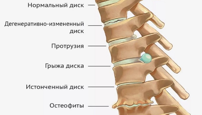 Остеохондроз шейного и поясничного отделов