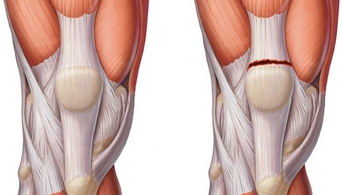 Сколько заживает разрыв коленных связок