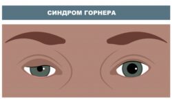 Причины и симптомы синдрома Горнера